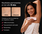 Lumero Pro™ | Laser Permanente