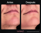 Lumero Pro™ | Laser Permanente