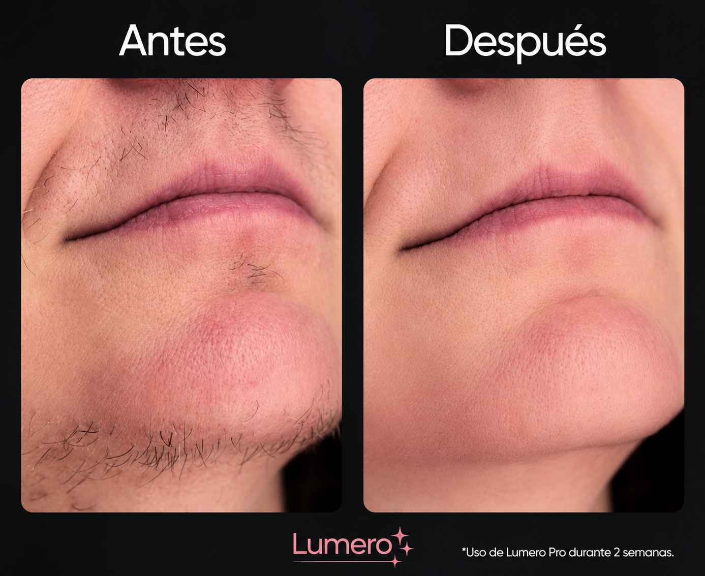 Lumero Pro™ | Laser Permanente