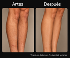 Lumero Pro™ | Laser Permanente