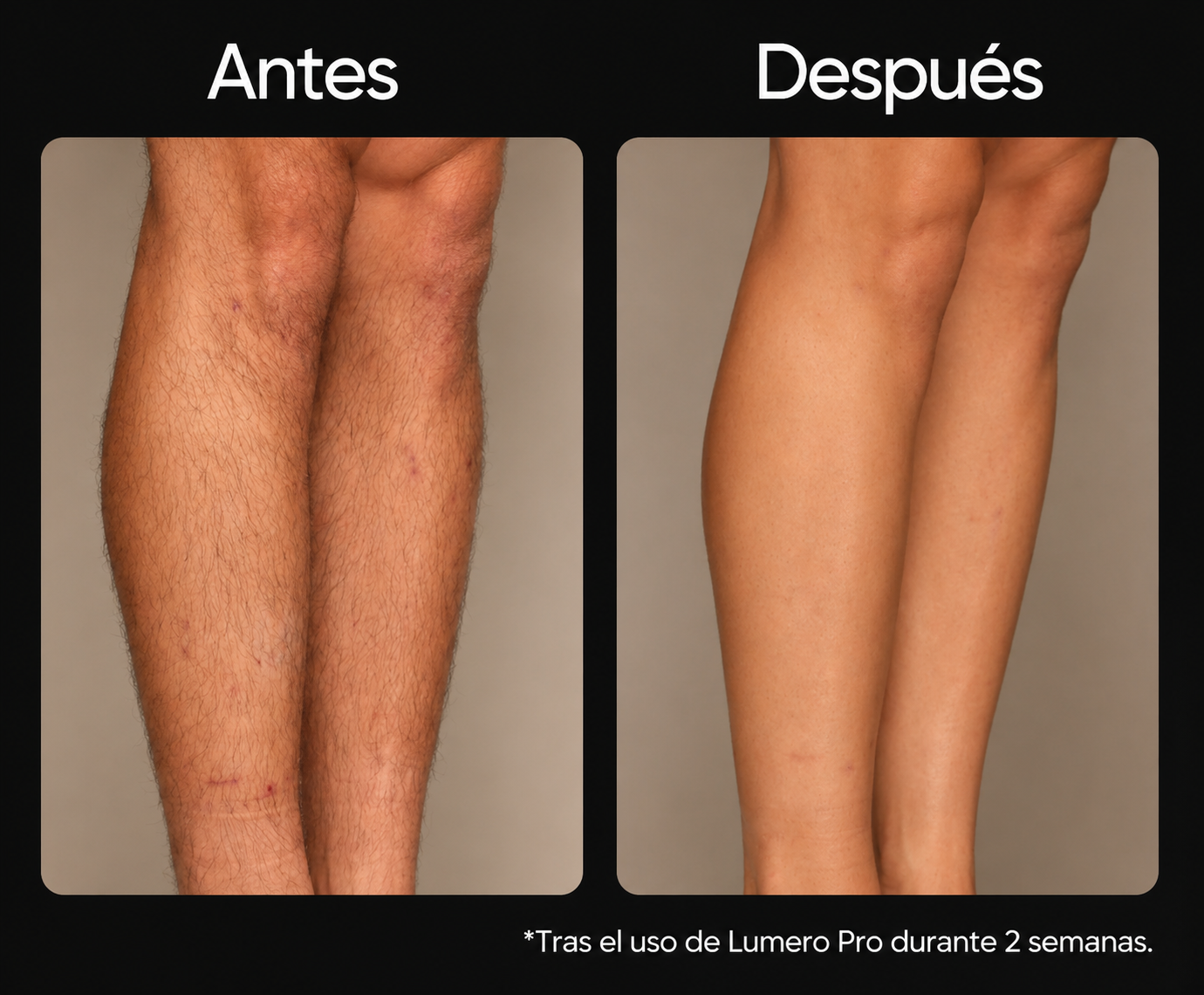 Lumero Pro™ | Laser Permanente