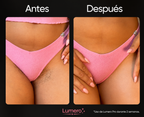 Lumero Pro™ | Laser Permanente